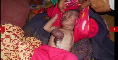 В Индии мальчик родился с сердцем вне тела — фото