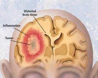 Рак головного мозга: как не пропустить первые симптомы