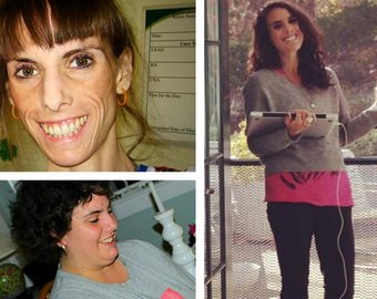 Умиравшая от анорексии девушка за год поправилась с 25 до 100 кило. И снова села на диету