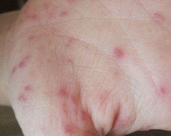 "Совершенно непонятно, как уберечься": рассказы пострадавших от таинственного вируса Коксаки