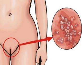 «Доктор, мне кажется, я заболел сифилисом»: венерические будни москвичей