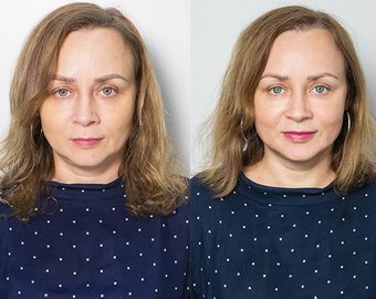 Филлеры и гиалуронка как альтернатива "пластике"