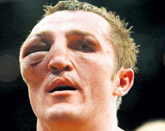 Какие серьёзные травмы получали наши спортсмены