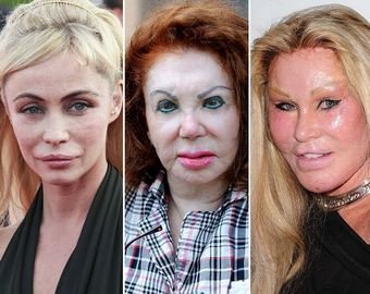 10 бывших красавиц, которых испортила пластика