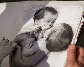 «Замуж еще успеем». «Комсомолка» узнала, как сложилась судьба первых разделенных в СССР сиамских близнецов