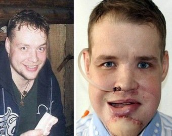 «Рисую, как художник». Хирург из Сибири по кусочкам «собирает» лица людей