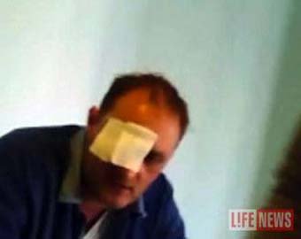 Зибров, потерявший глаз в драке, требует от обидчика  000