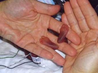 Самый недоношенный ребенок в мире родился в Германии