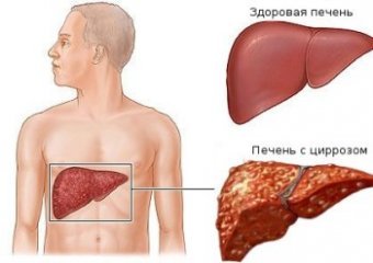 Российские ученые создали первый в мире препарат от цирроза печени