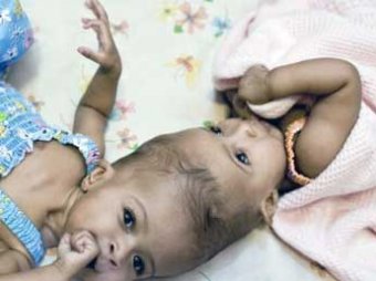 Британские медики разделили сиамских близнецов, сросшихся головами