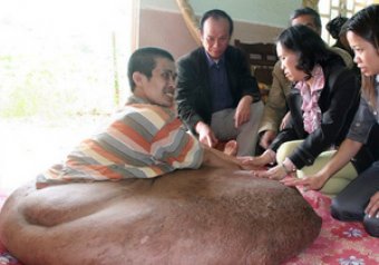 Жителю Вьетнама удалили 90-килограмовую опухоль