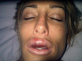 В Британии хирурги изуродовали лицо модели, увеличив ей губы