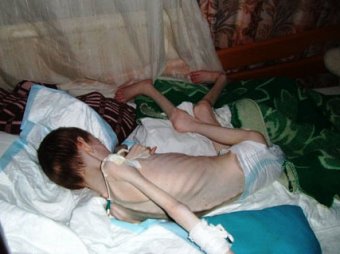 В Кемеровской области от голода умерли 27 воспитанников интерната: директор "ни при чем"