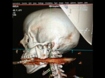 В Бразилии женщина выжила после того, как ей в рот попал стальной гарпун