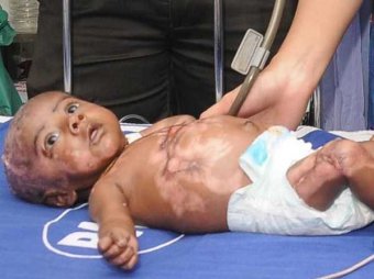 В Индии трёхмесячный младенец страдает от самовоспламенения