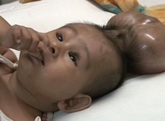 В Индии врачи спасли жизнь мальчику, родившемуся с двумя головами