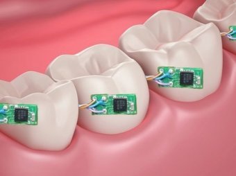 Учёные создали "умный" зуб
