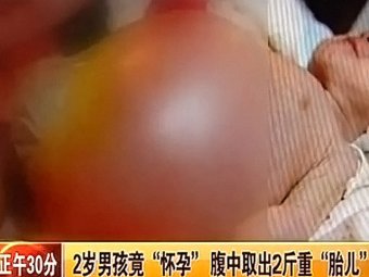 В Китае двухлетний мальчик "родил" брата-близнеца