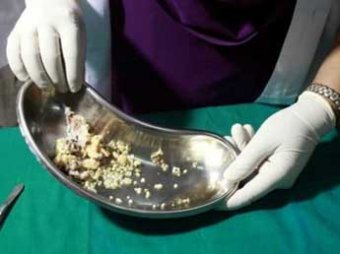 Шок: в Индии врачи вырвали у 7-летней девочки 202 зуба