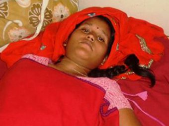 В Индии женщина родила сиамских близнецов с редким типом срастания