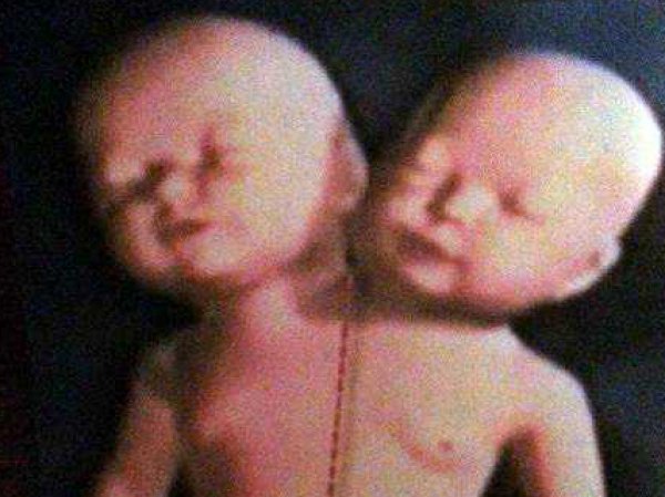 В США родился ребенок с двумя головами