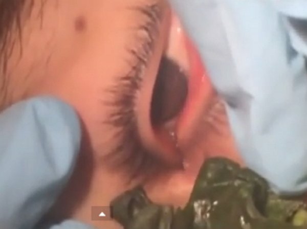 17-летний подросток прожил более месяца с червем в глазу