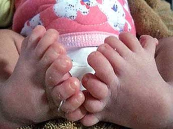 В Китае родился ребенок с 31 пальцем на руках и ногах