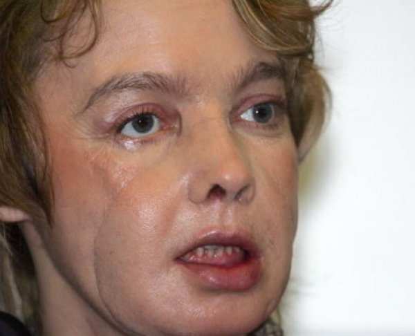 Умерла Изабель Динуар — первый в мире человек, переживший пересадку лица (ФОТО)