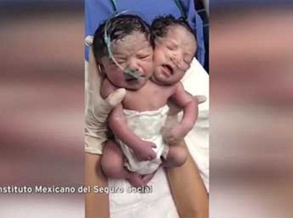 В Мексике родился мальчик с двумя головами (ВИДЕО)