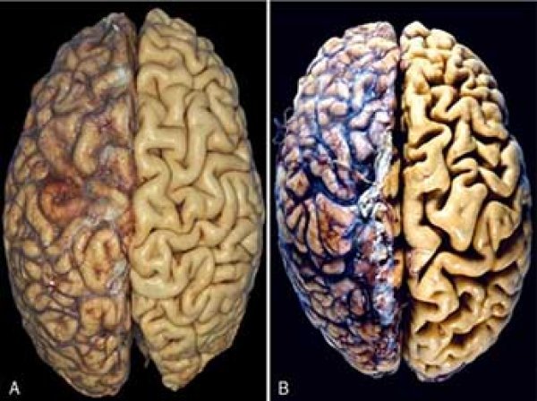 Ученые назвали популярный напиток, который может вызвать атрофию мозга