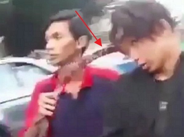 Индонезийский драчун добрался до больницы с серпом во лбу