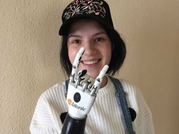 Оставшаяся без рук Маргарита Грачева рассказала, как ей живется с бионическим протезом