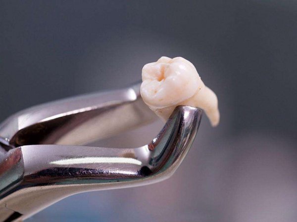 В Тюмени врачи удалили из носа жаловавшейся на гайморит девушки зуб