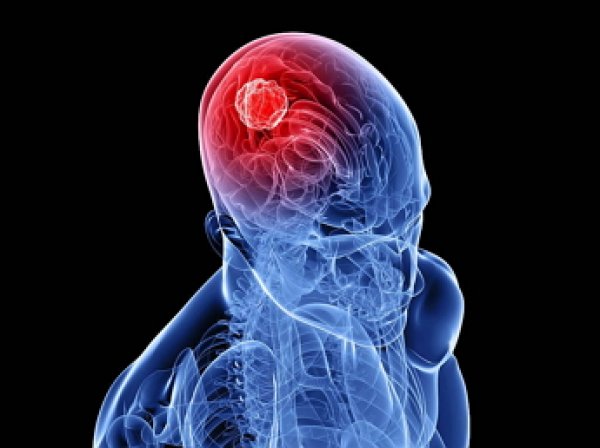 Больные раком мозга назвали первые симптомы, которые показались им странными