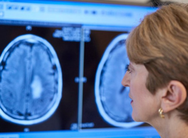 Эксперты назвали первые сигналы рака головного мозга