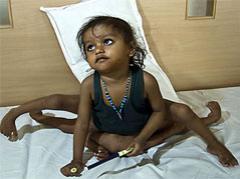 Четырёхрукую индианку лишат  конечностей