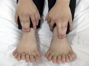 Маленькому китайцу удалили 11 лишних пальцев