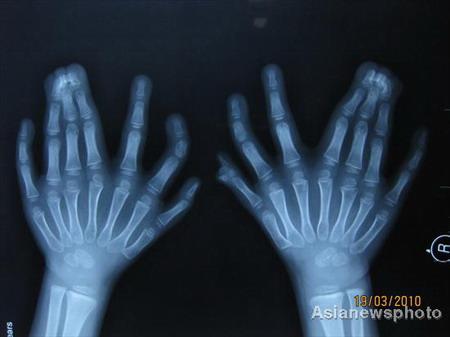 Маленькому китайцу удалили 11 лишних пальцев