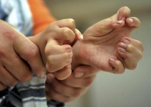 Маленькому китайцу удалили 11 лишних пальцев