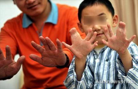 Маленькому китайцу удалили 11 лишних пальцев