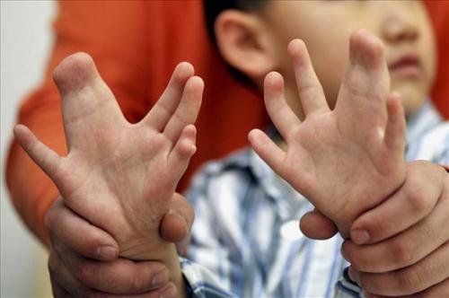 Маленькому китайцу удалили 11 лишних пальцев