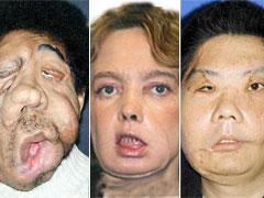 Пересаженные лица прижились