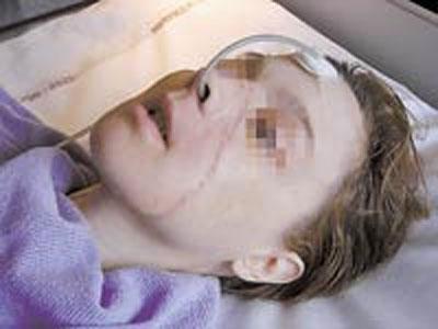 Пересаженные лица прижились