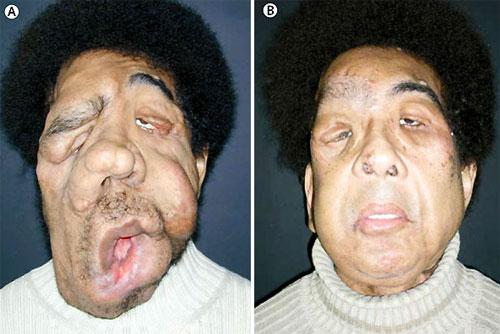 Пересаженные лица прижились