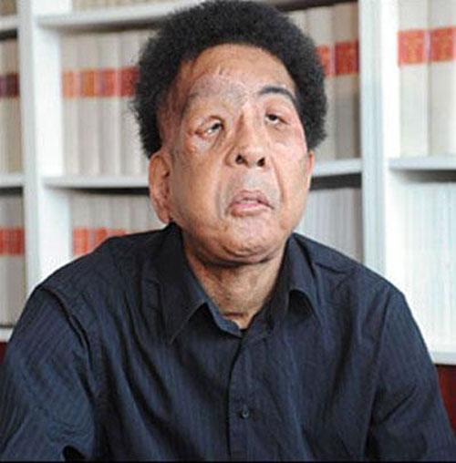 Пересаженные лица прижились