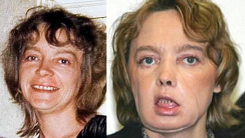 Пересаженные лица прижились