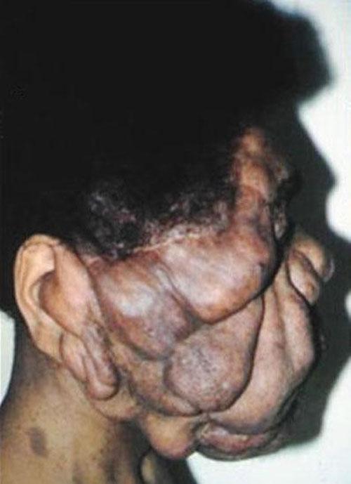 Пересаженные лица прижились