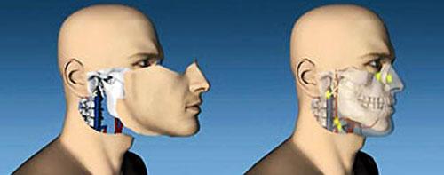 Пересаженные лица прижились