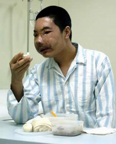 Пересаженные лица прижились