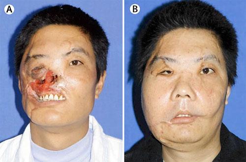 Пересаженные лица прижились